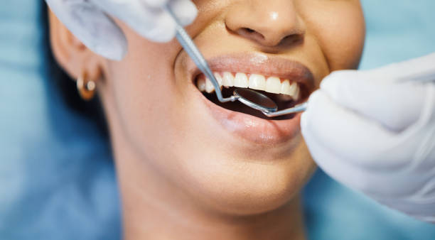 Best Knocked-Out Tooth (Avulsed Tooth) Treatment in Huxley, IA